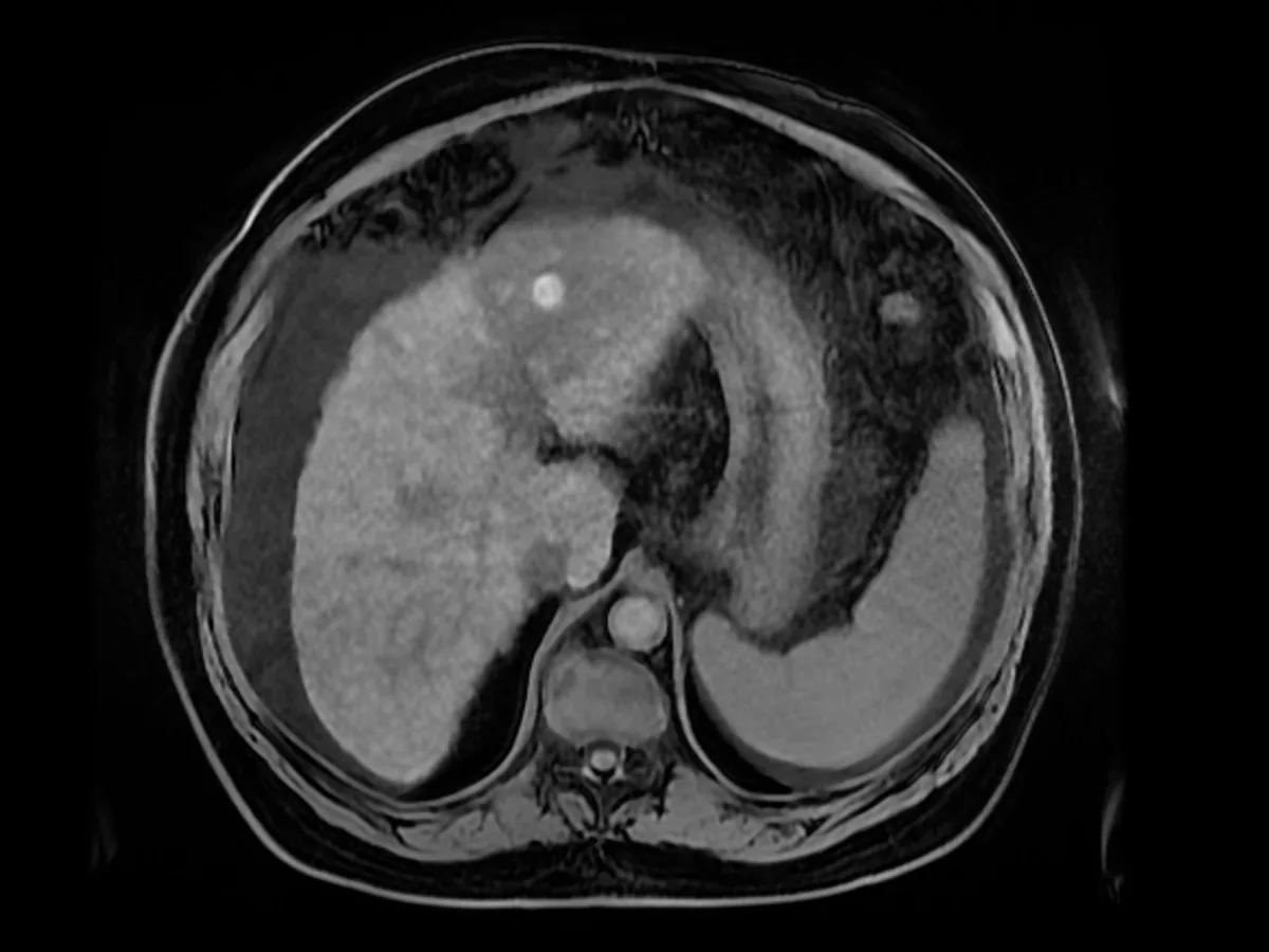 Control MRI after electroporation of a liver tumour: the oedema marks the treated zone